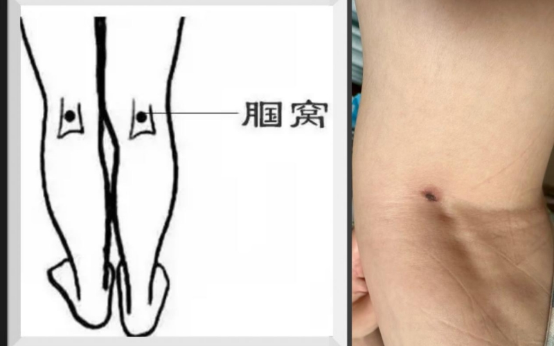 恙蟲病東方體。